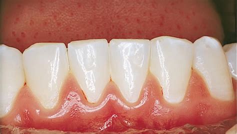 14 Periodontal Conditions Pocket Dentistry