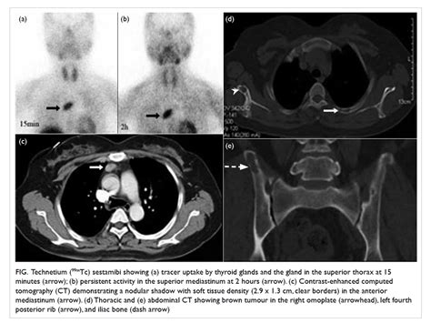 Primary Hyperparathyroidism Caused By Mediastinal Ectopic Parathyroid