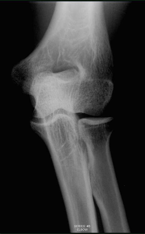 Normal Elbow On X Ray X Rays Case Studies Ctisus Ct Scanning