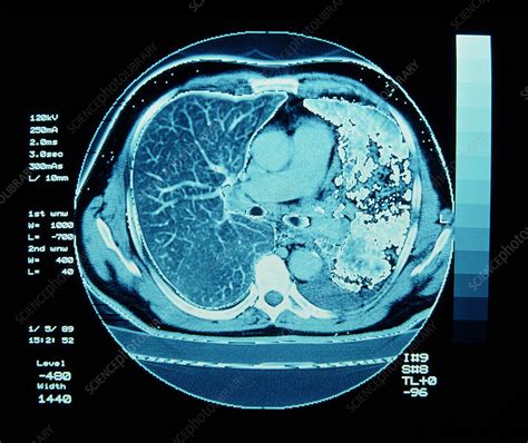 CT scan on chest showing lung cancer - Stock Image - M134/0071