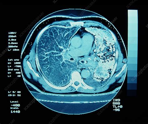 Ct Scan On Chest Showing Lung Cancer Stock Image M