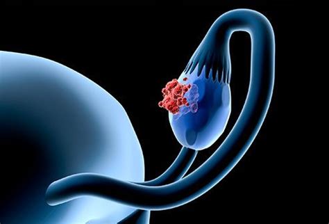Learn the cancer symptoms to detect it early. Ovarian Cancer Symptoms, Survival Rate, Treatment & Diagnosis
