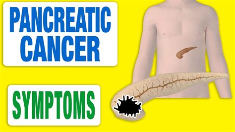 Pancreatic Cancer All Symptoms Youtube