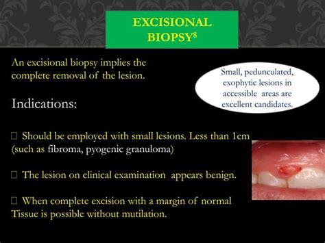 Oral Biopsy Ppt
