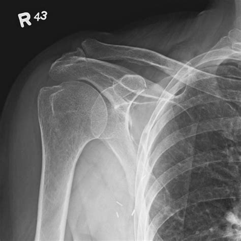 Shoulder Ap Internal X Ray Ubicaciondepersonascdmxgobmx