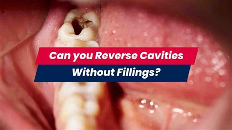 Can You Reverse Cavities And Not Get Fillings