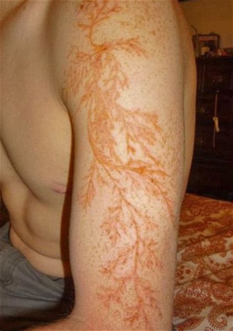 This Is What Happens To Human Skin When It S Struck By Lightning It S Called A Lichtenberg