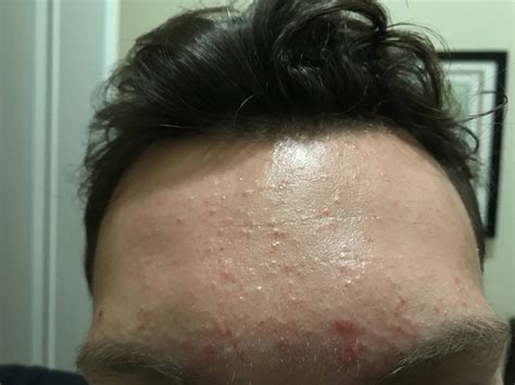 Skin Concern Tiny Bumps On Forehead Please Help R