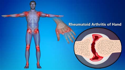 Rheumatoid Arthritis Of Hands Symptoms Signs Treatment Youtube
