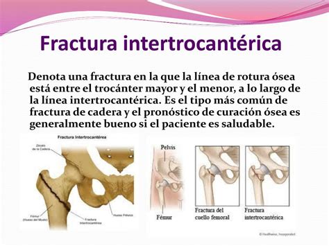 Ppt Fracturas De Cadera Powerpoint Presentation Free Download Id