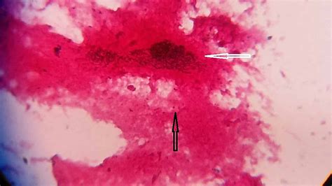 Corynebacterium Diphtheriae Pharyngitis