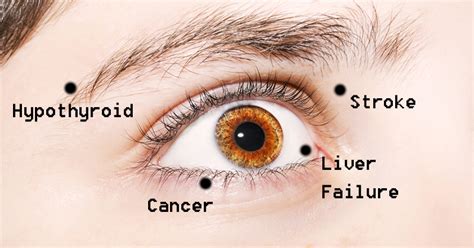 (i) what color eyes do you have? Red Flags: 7 Life-Threatening Health Conditions that Your ...