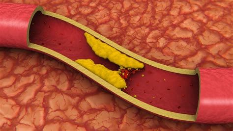 Clogged Arteries May Be Down To Bacteria Not Diet