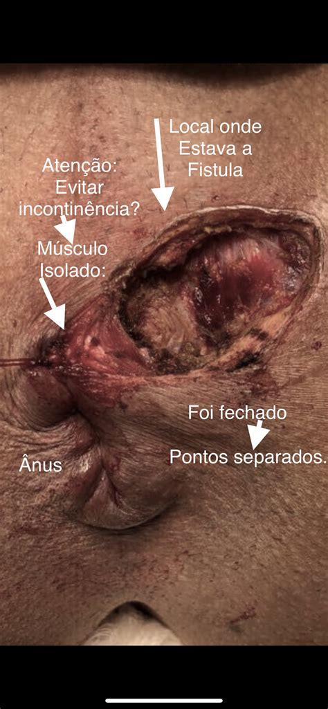 Perianal abscess — infobox disease name 2010. Fistula perianal com trajeto transesfincteriana e ...