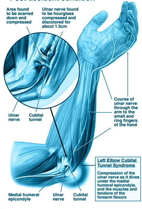Dr Carlos Godoy Lesión Por Compresión Del Nervio Cubital