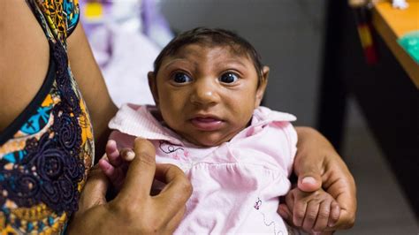 Zika Virus Damages Babies Brains After Birth Doctors Report Nbc News