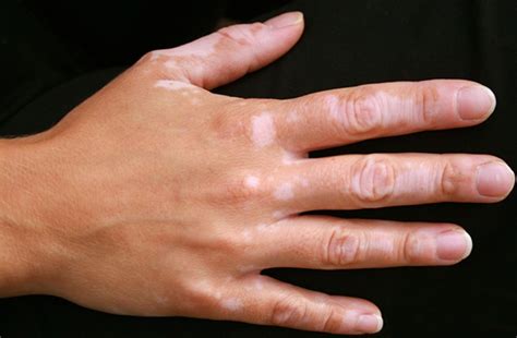 Vitiligo Pictures Symptoms Causes Treatment
