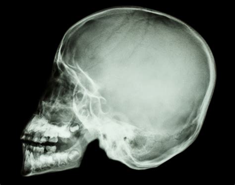 Skull X Ray 708x556 2x