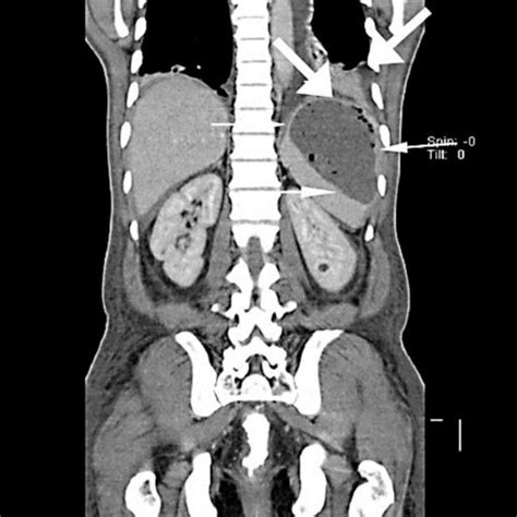 CT Scan Of The Abdomen Showing Splenic Abscess Thin White Arrows With