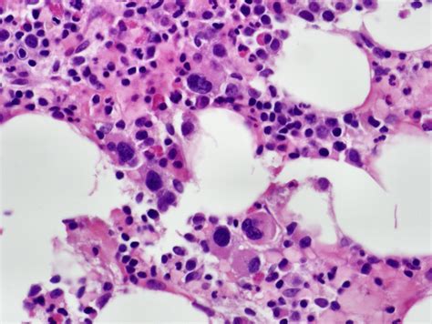 Bone marrow biopsy a biopsy collects a cylindrical core sample that preserves the marrow's structure. Normocellular bone marrow with progressive trilineage ...