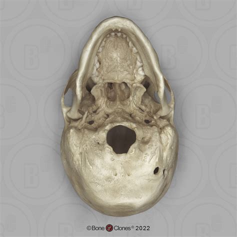 Human Female Skull With Multiple Gunshot Wounds Bone Clones Inc