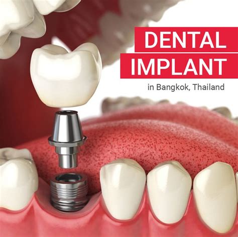 Pin On Dental Implants In Thailand