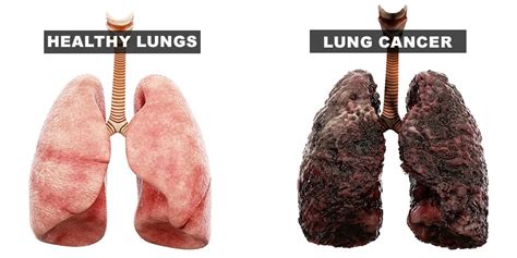 Cigarettes Before And After Lungs