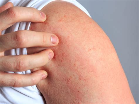 La Dermatitis Atópica Impacta Emocionalmente Salud