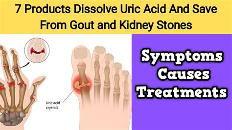 Foods To Lower Uric Acid Level Naturally 7 Products Dissolve Uric Acid Youtube