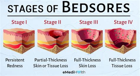 How To Heal Bedsores Explained By A Physician Emedihealth