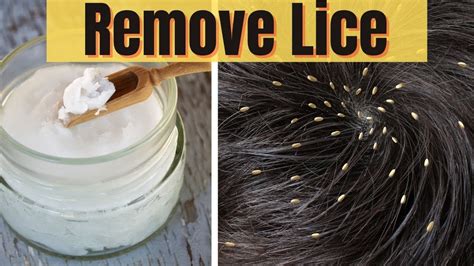 In 1 Day Remove Head Lice Permanently Nits And Eggs From Hair Naturally
