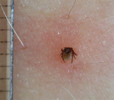 Ticks On Humans Risks And What Hikers And Runners Need To Know