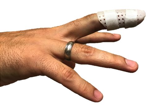 Mallet Finger Raleigh Hand Surgery — Joseph J Schreiber Md