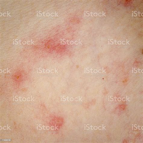 Allergische Ausschlag Dermatitis Eczema Haut Stockfoto Und Mehr Bilder