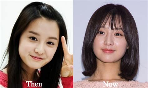Kim Ji Won Plastic Surgery Before And After Photos