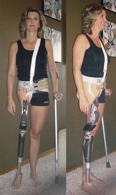 Amputee Lady Amputee Model Orthotics And Prosthetics Prosthetic Leg