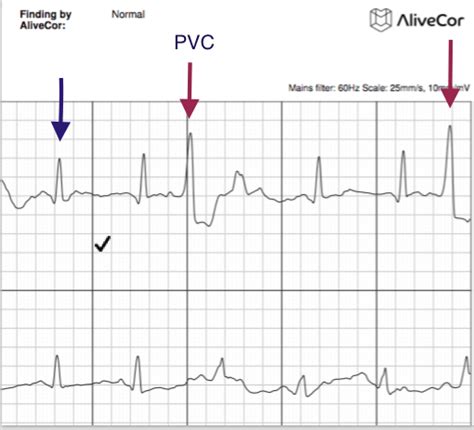 V Paced Big Pvcs The Skeptical Cardiologist