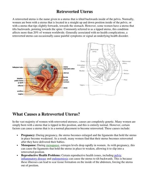 Retroverted Uterus What Causes A Retroverted Uterus Docslib