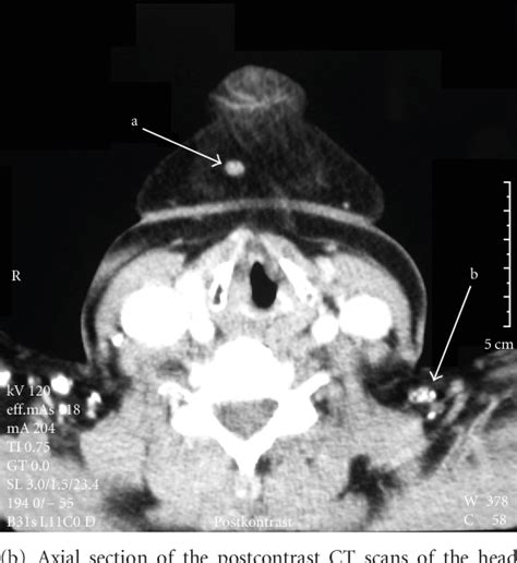 Figure 3 From Unilateral Aplasia Of The Submandibular Gland With