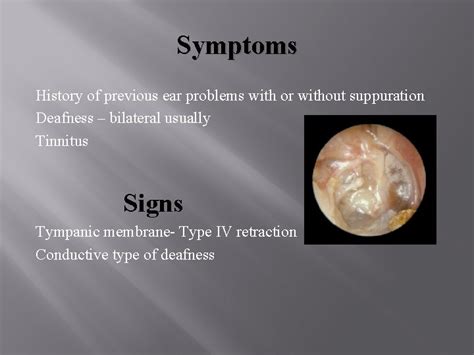 Otitis Media With Effusion Tuberculous Otitis Media Tympanosclerosis