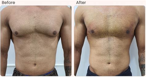 The Price Of Gynecomastia Surgery What To Expect
