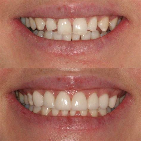 What You Need To Know About Dental Veneers Forever Dental And Skin