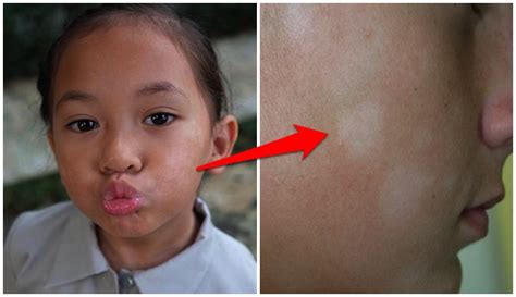Folliculitis folliculitis is een ontsteking van enkele haarzakjes. Pityriasis Alba, Penyakit Kulit Mirip Panu yang Dipercaya ...
