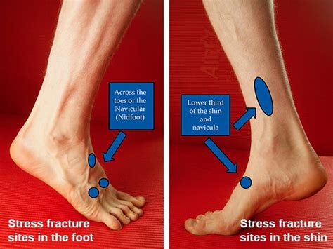 Stress Fractures Diagnosis And Recovery