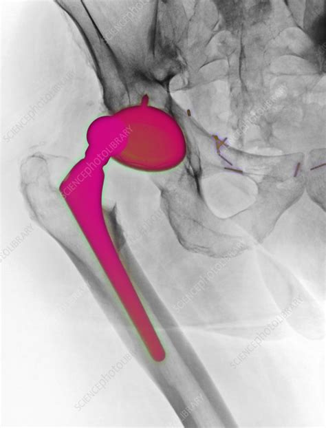 Dislocated Hip Replacement Stock Image C0094791 Science Photo