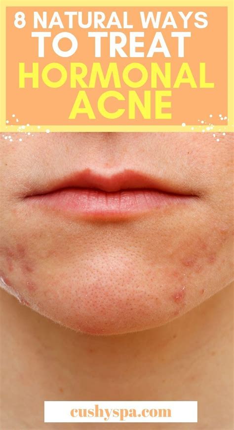 How To Treat Hormonal Acne Naturally 8 Treatments Natural Acne