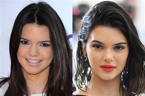 Kendall Jenner Lip Injections And Plastic Surgery