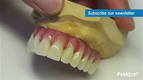 Pekk Pekktron Peek Dental Uses Pekk Frameworks Bauer Smiles