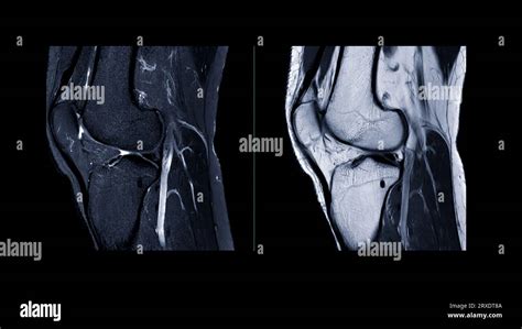 Magnetic Resonance Imaging Of Knee Joint Or Mri Knee Sagittal For