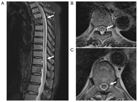 T 2 Weighted Magnetic Resonance Images Of Thoracic Vertebra In Case 2